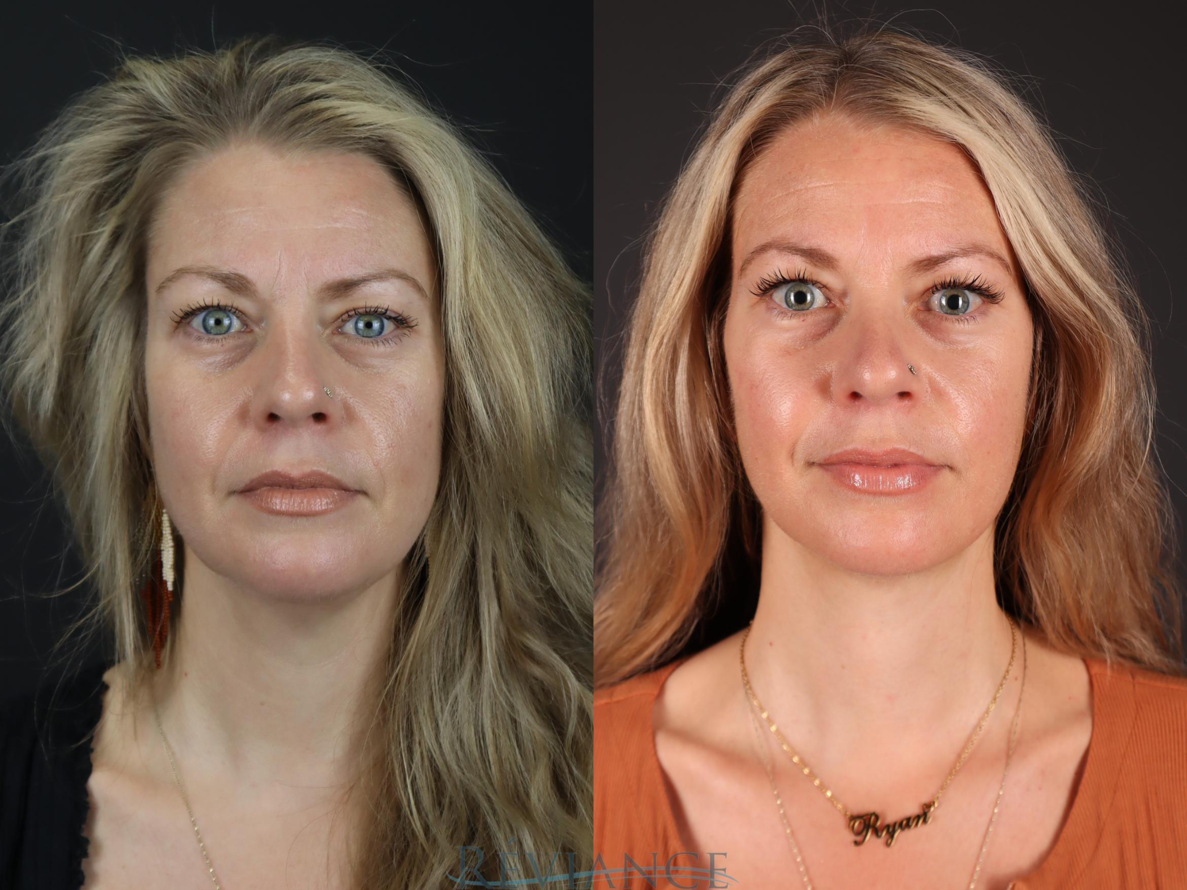 Before & After Facelift Case 2227 Front View in Portland, OR