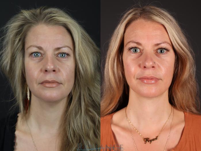 Before & After Facelift Case 2227 Front View in Portland, OR