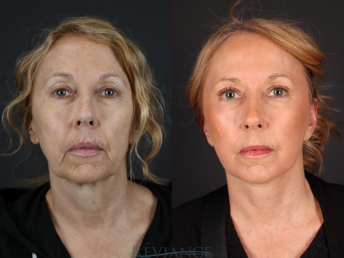 Before & After Facelift Case 2229 Front View in Portland, OR