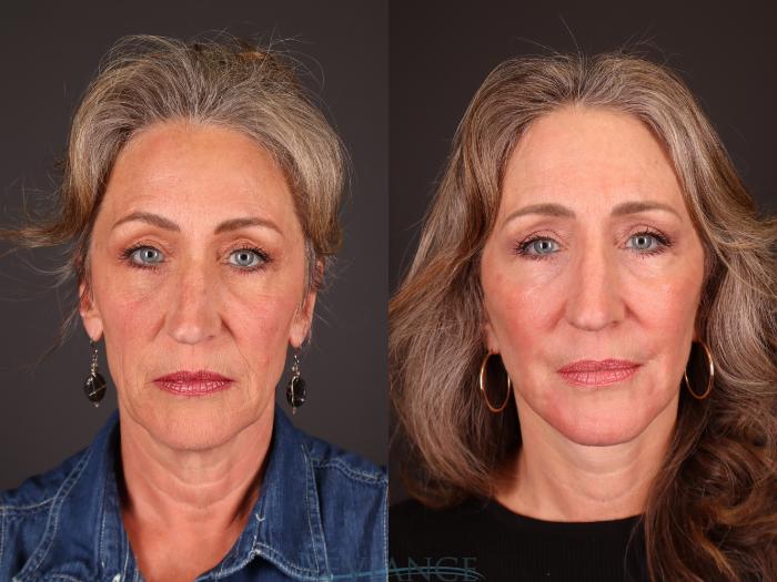 Before & After CO2 Fractional Laser Case 2234 Front View in Portland, OR