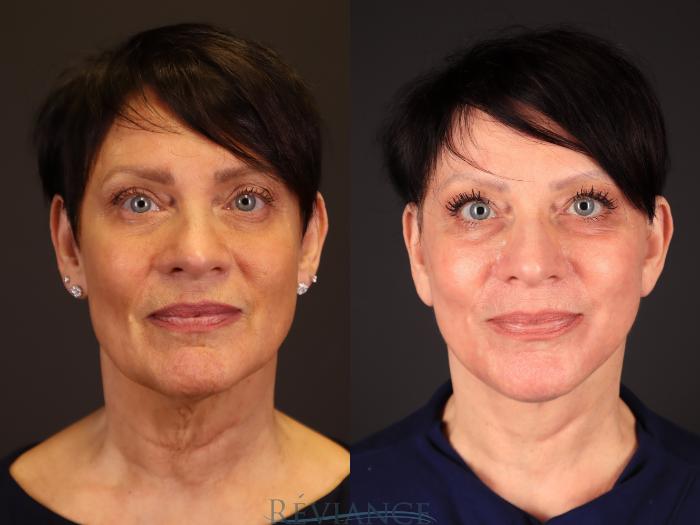Before & After CO2 Fractional Laser Case 2236 Front View in Portland, OR