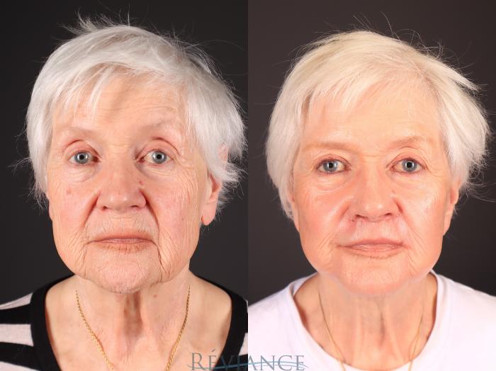 Before & After CO2 Fractional Laser Case 2251 Front View in Portland, OR