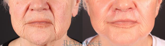 Before & After CO2 Fractional Laser Case 2252 Front View in Portland, OR