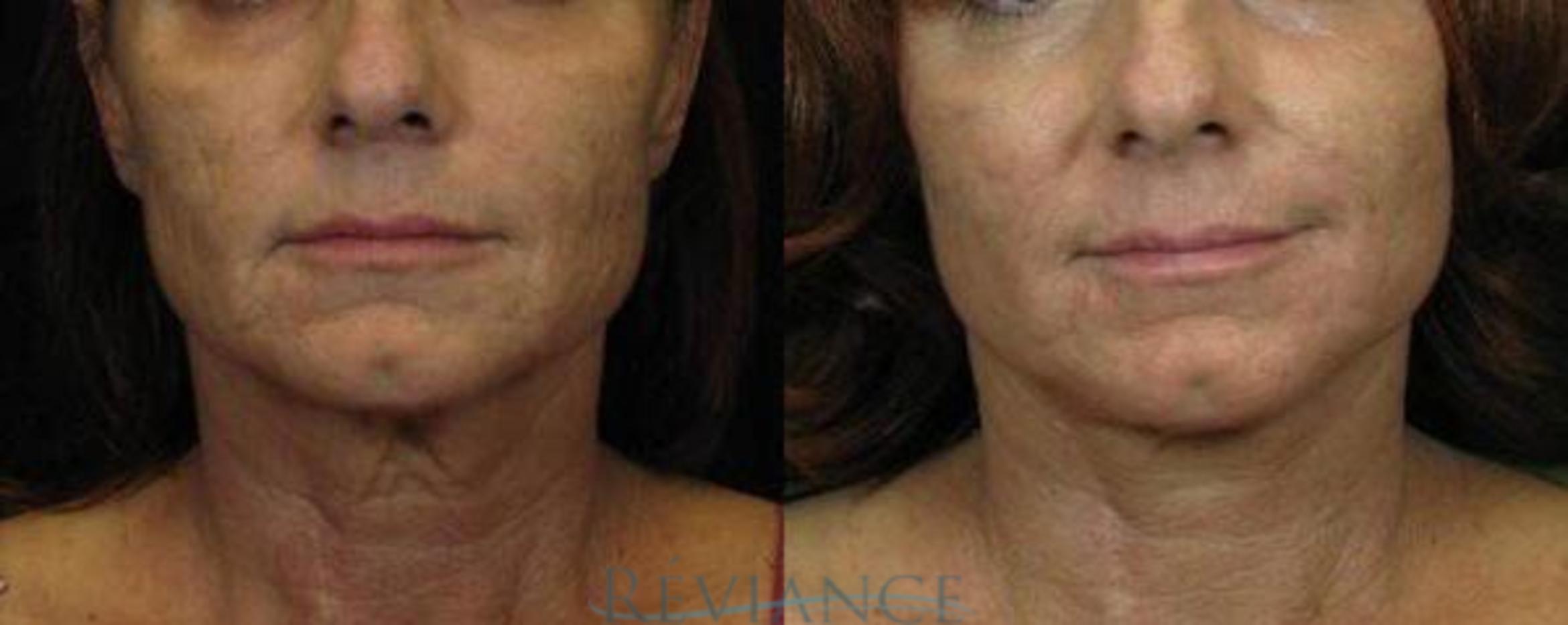 Before & After Mini Facelift Case 79 View #1 View in Portland, OR