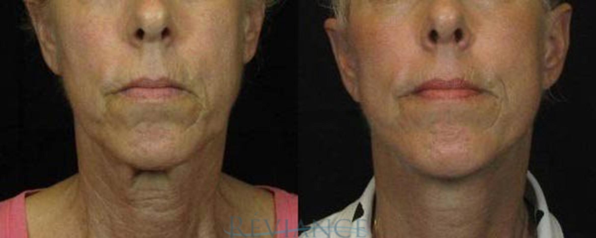 Before & After Mini Facelift Case 89 View #1 View in Portland, OR