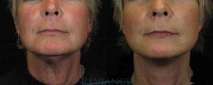 Before & After Minifacelift Case 2200 Front View in Portland, OR