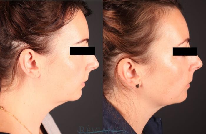 Before & After Ultherapy Case 2247 Left Side View in Portland, OR