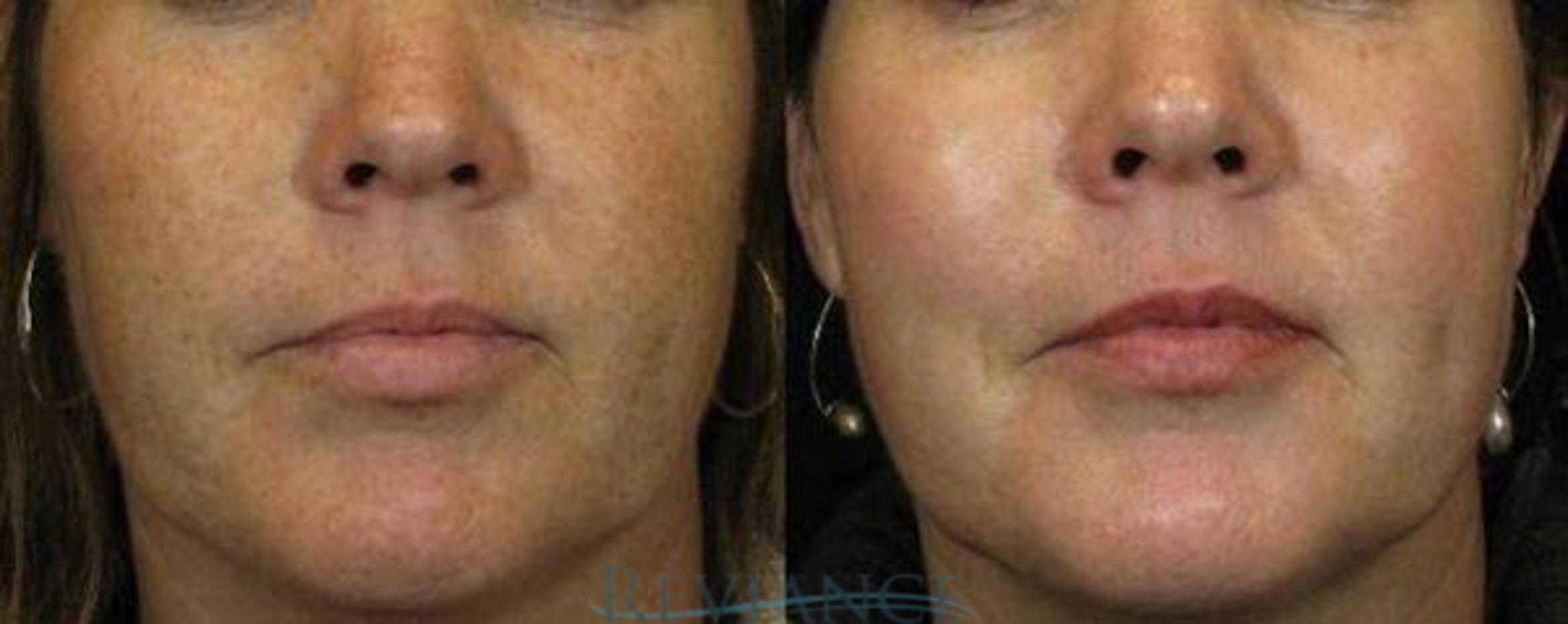 Before & After IPL Photo-facial Case 21 View #1 View in Portland, OR