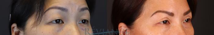 Before & After Asian Blepharoplasty Case 2233 3/4 View in Portland, OR