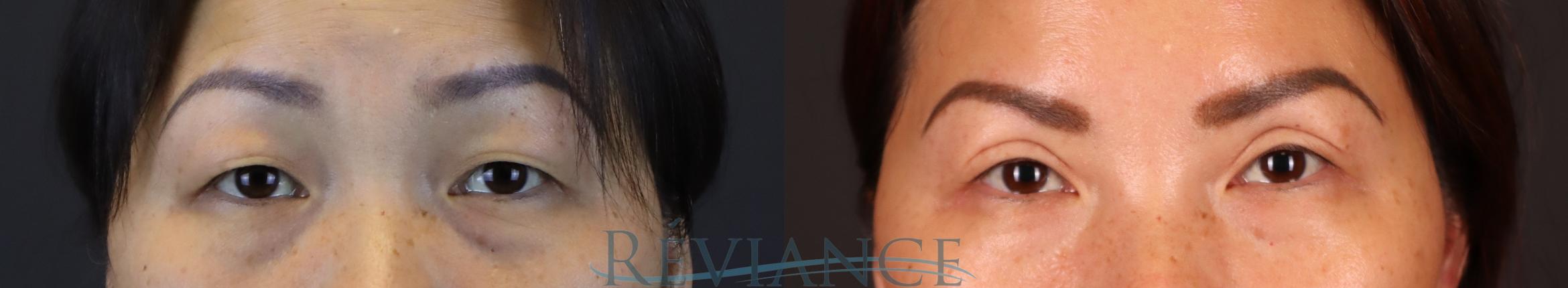 Before & After Asian Blepharoplasty Case 2233 Front View in Portland, OR