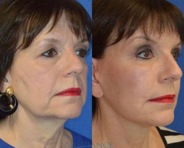 Before & After BeautiFill Fat Grafting Case 1633 View #1 View in Portland, OR