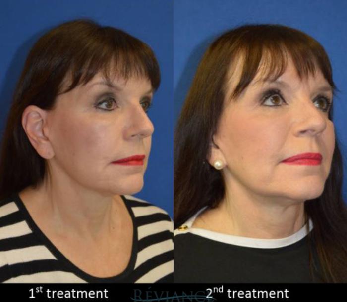 Before & After BeautiFill Fat Grafting Case 1633 View #3 View in Portland, OR