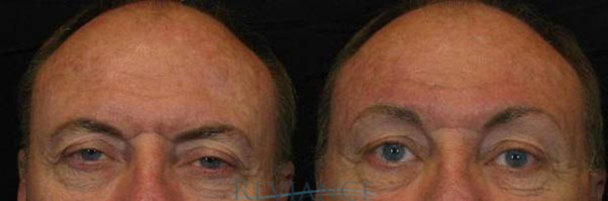 Before & After Brow Lift Case 169 View #1 View in Portland, OR