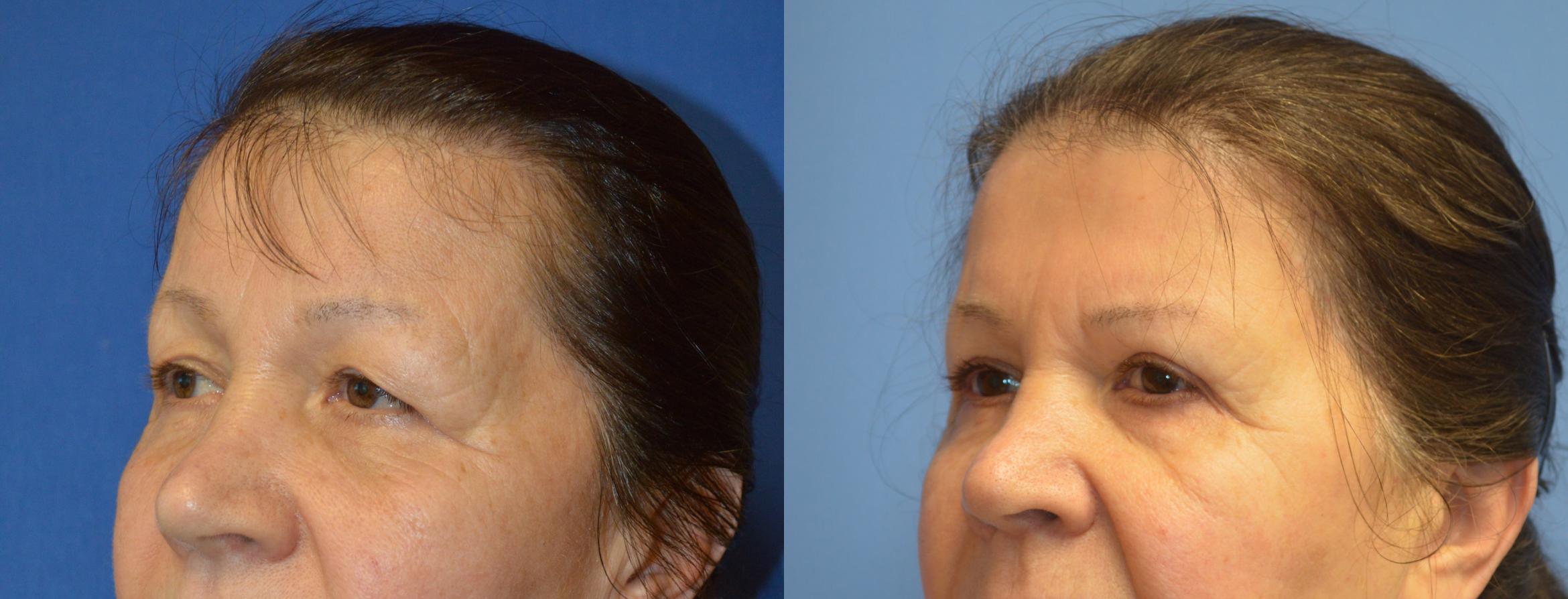 Browlift and blepharoplasty