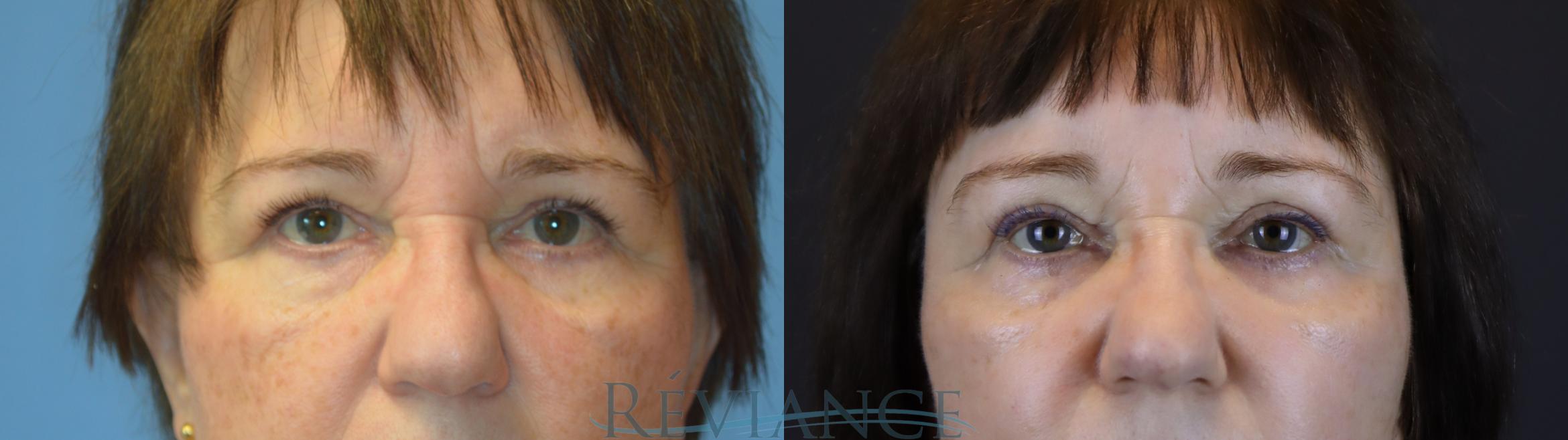 Endoscopic browlift and blepharoplasty