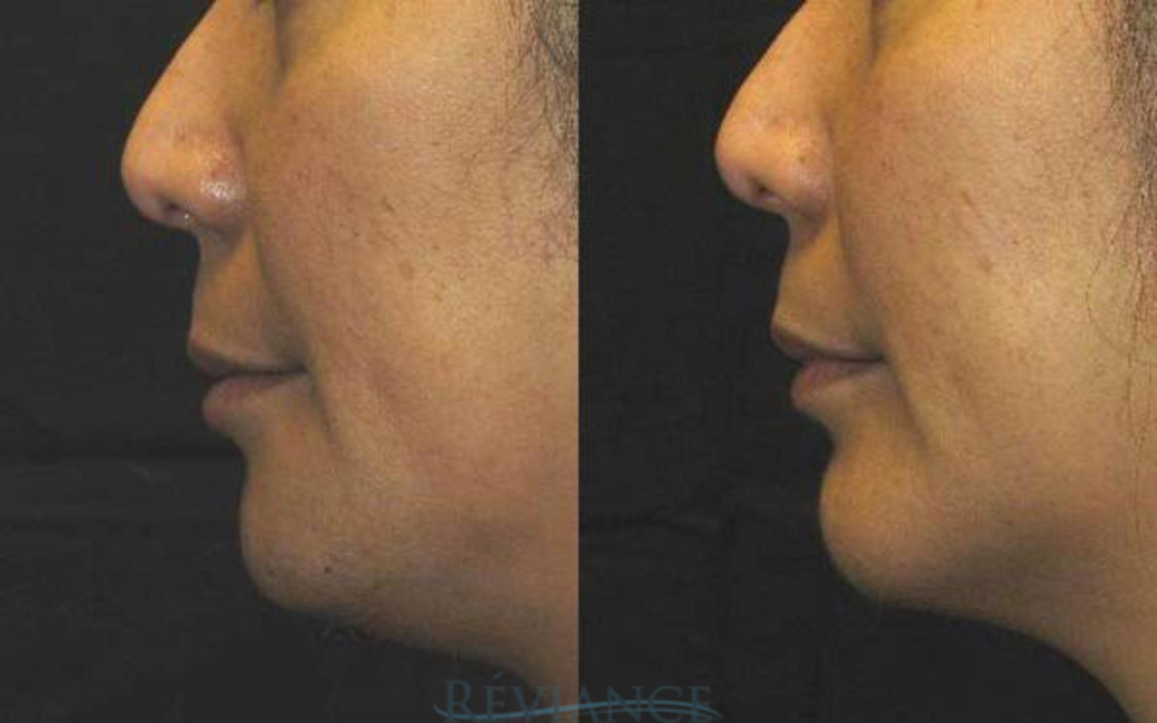 Before & After Chin Implants Case 109 View #1 View in Portland, OR