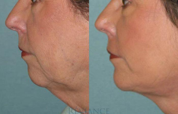 Before & After Chin Implants Case 113 View #1 View in Portland, OR