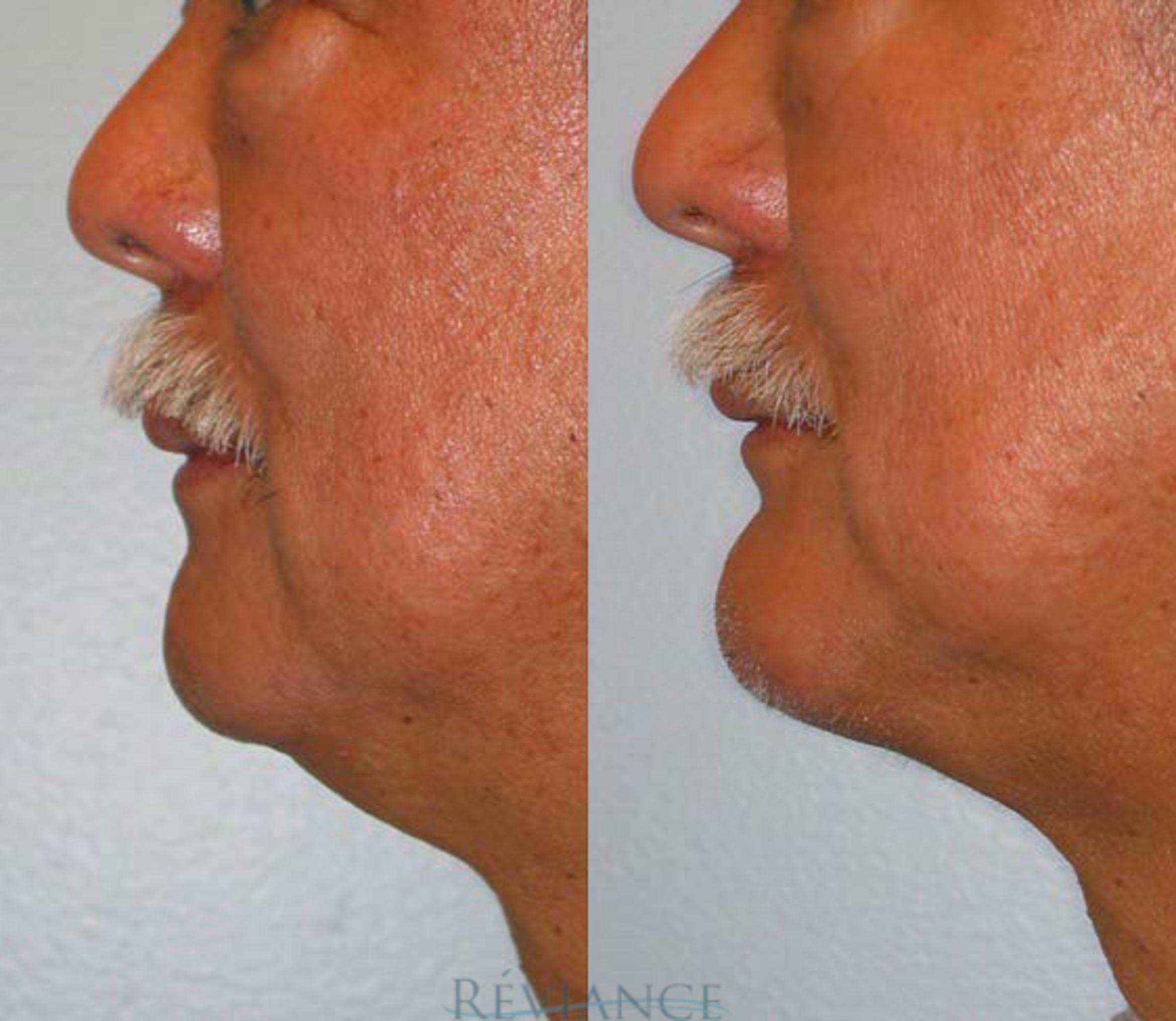 Before & After Chin Implants Case 117 View #1 View in Portland, OR