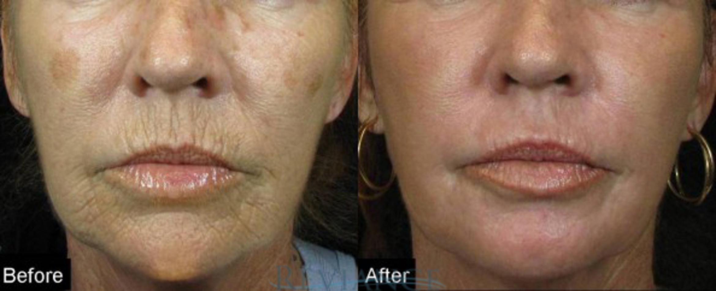 Before & After CO2 Fractional Laser Case 250 View #1 View in Portland, OR