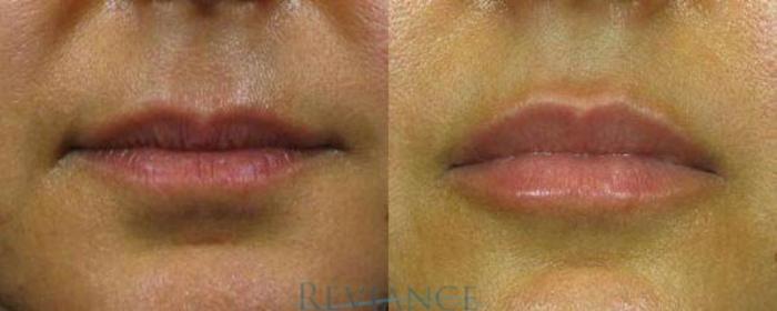 Before & After Dermal Fillers Case 230 View #1 View in Portland, OR