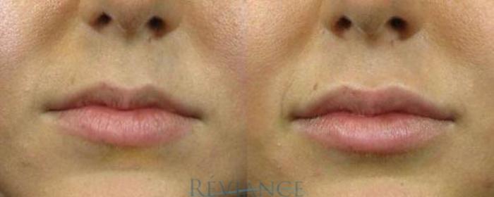 Before & After Dermal Fillers Case 246 View #1 View in Portland, OR
