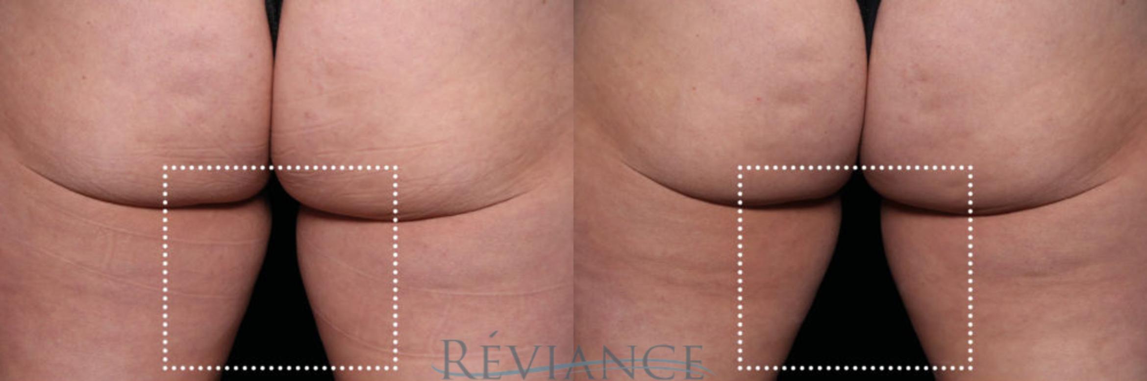 Before & After EMSCULPT Neo Case 1834 View #1 View in Portland, OR
