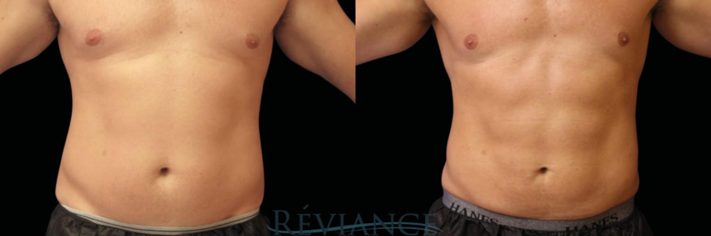 Before & After EMSCULPT Neo Case 1842 View #1 View in Portland, OR