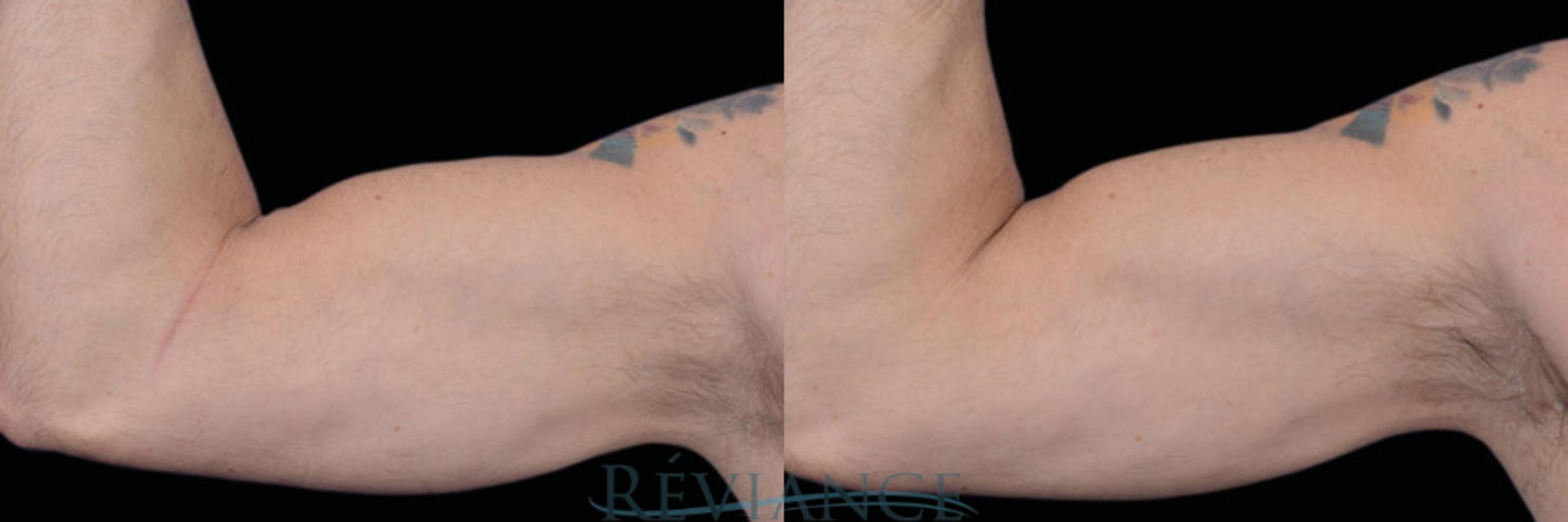 Before & After EMSCULPT Neo Case 1854 View #1 View in Portland, OR