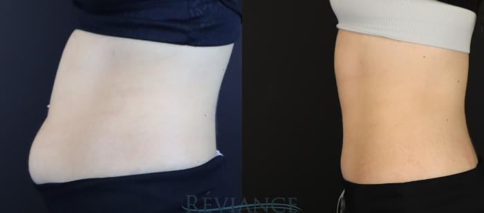 Before & After EMSCULPT Neo Case 2223 Left Side View in Portland, OR