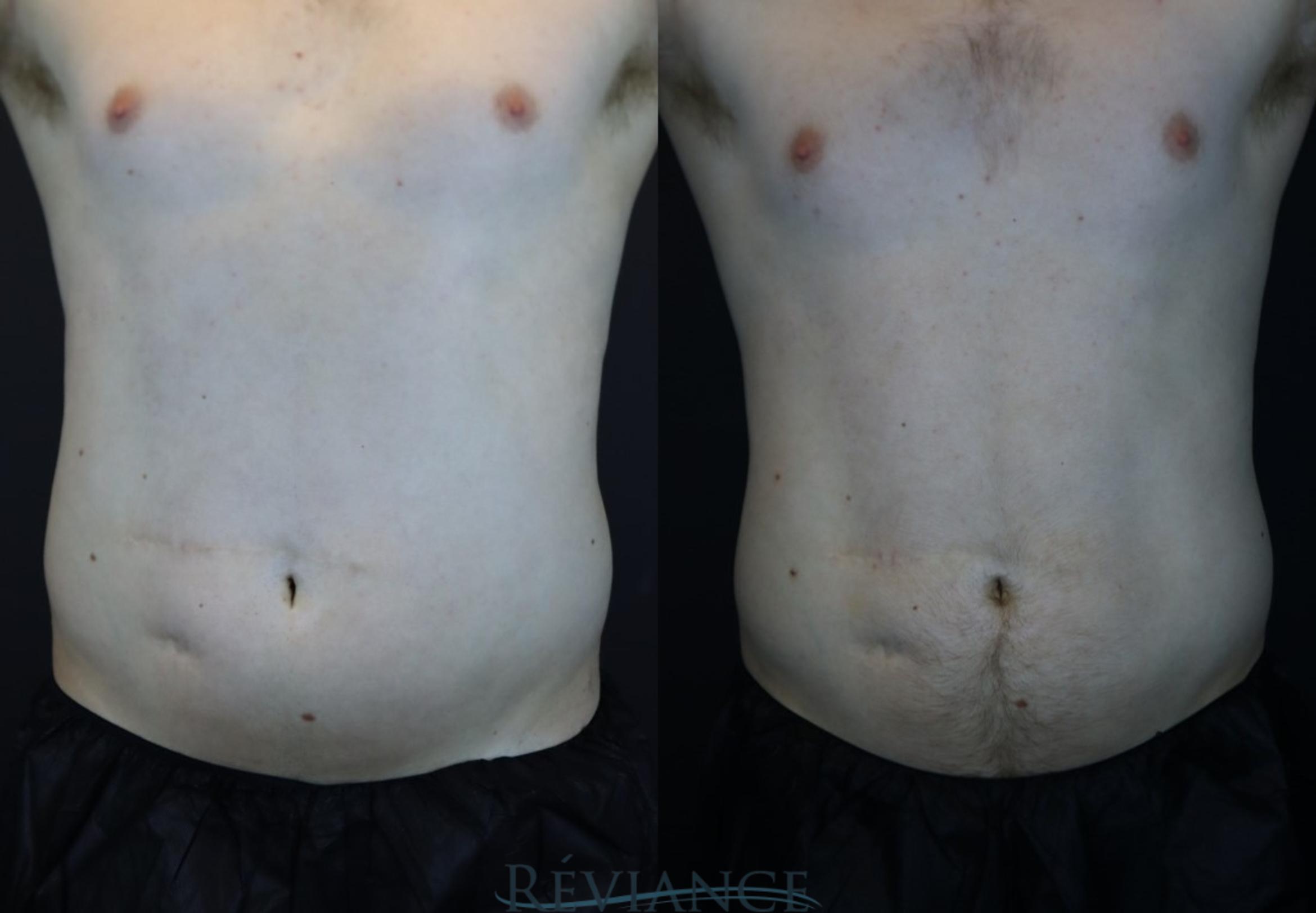 Before & After EMSCULPT Neo Case 2224 Front View in Portland, OR