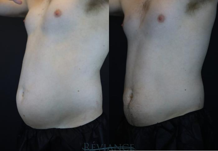 Before & After EMSCULPT Neo Case 2224 Left Oblique View in Portland, OR