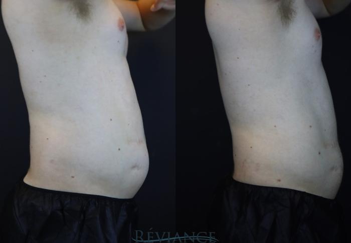 Before & After EMSCULPT Neo Case 2224 Right Side View in Portland, OR