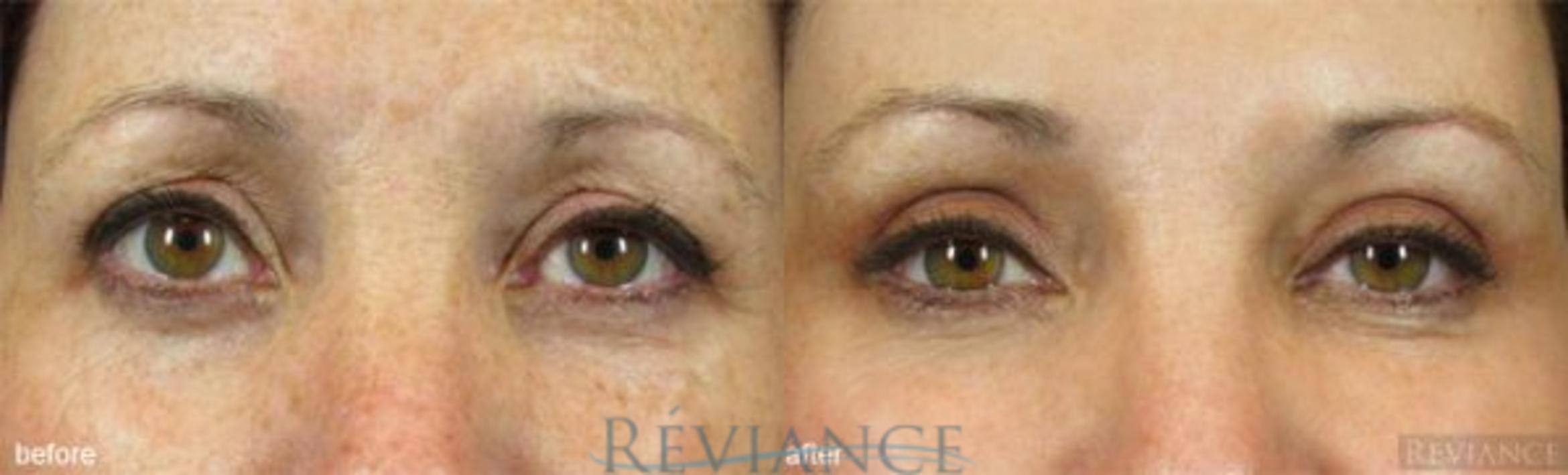 Before & After Eyelid Surgery Case 121 View #1 View in Portland, OR