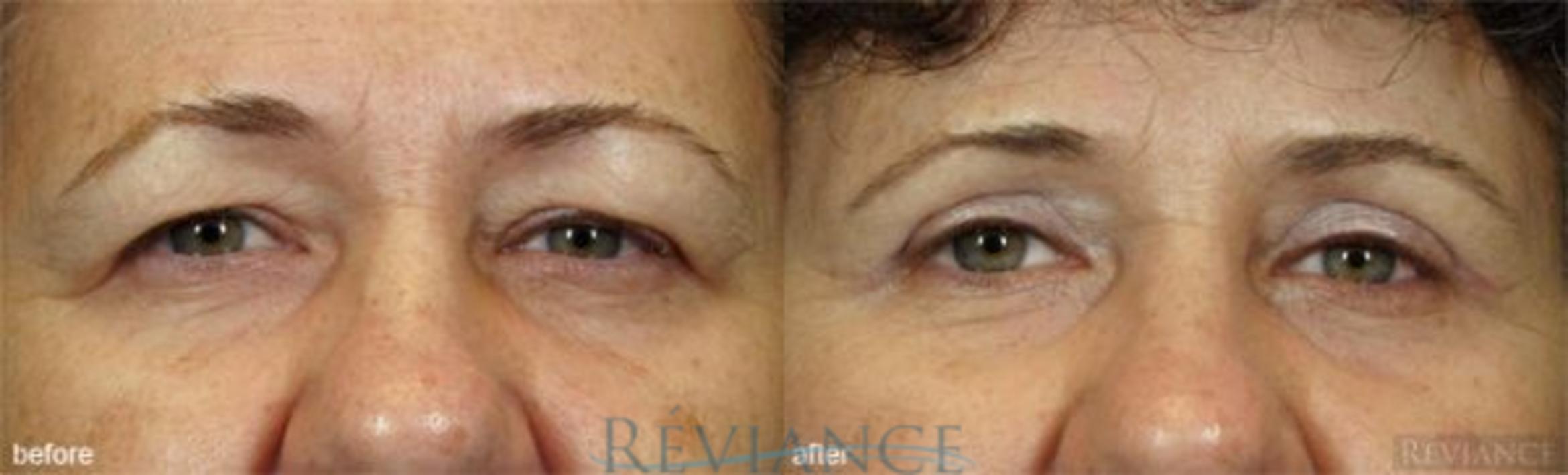 Before & After Eyelid Surgery Case 125 View #1 View in Portland, OR