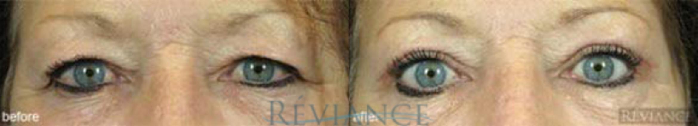 Before & After Eyelid Surgery Case 129 View #1 View in Portland, OR