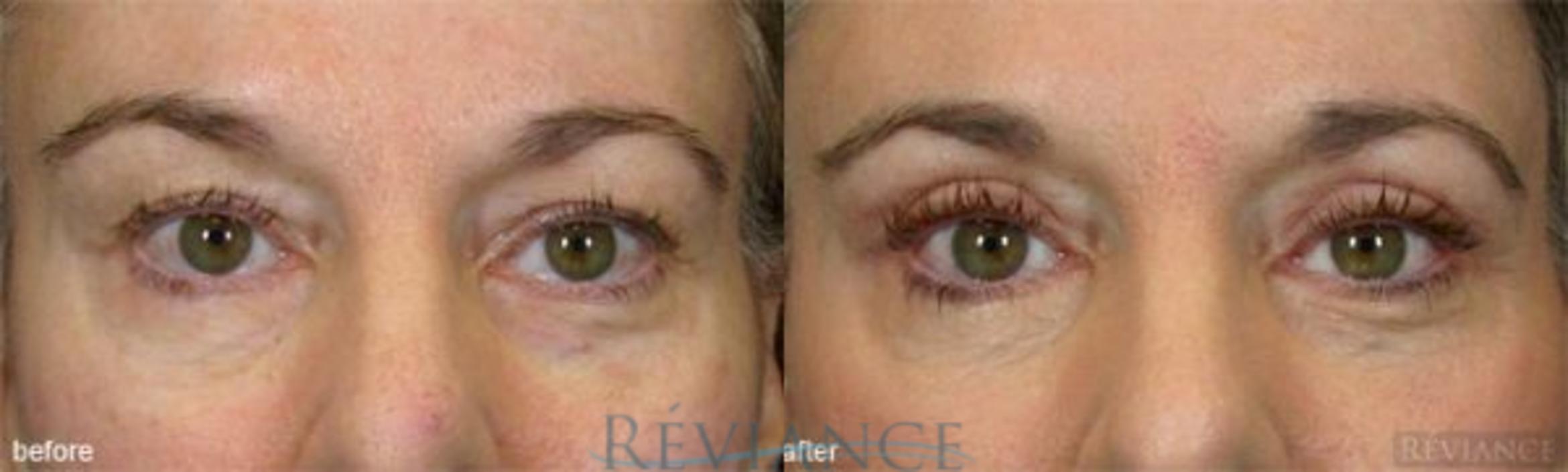 Before & After Eyelid Surgery Case 133 View #1 View in Portland, OR