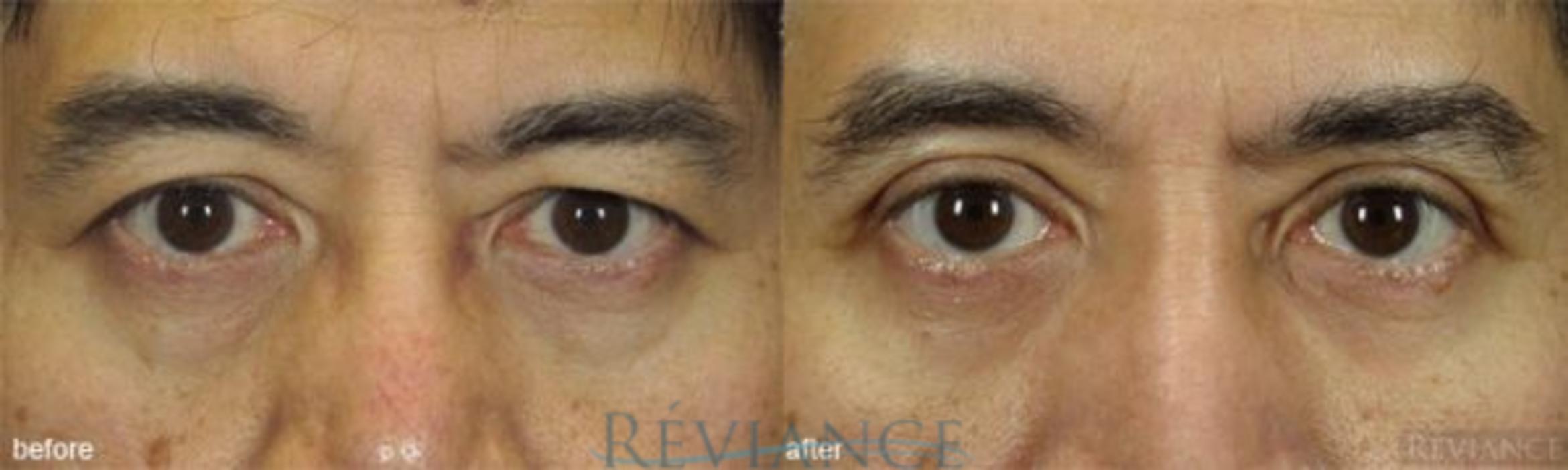 Before & After Eyelid Surgery Case 137 View #1 View in Portland, OR