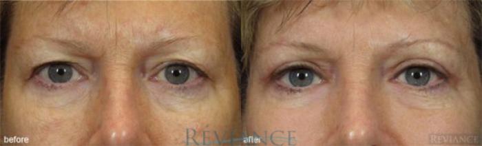 Before & After Eyelid Surgery Case 141 View #1 View in Portland, OR
