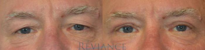 Before & After Eyelid Surgery Case 1444 View #1 View in Portland, OR