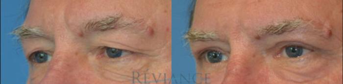 Before & After Eyelid Surgery Case 1444 View #2 View in Portland, OR