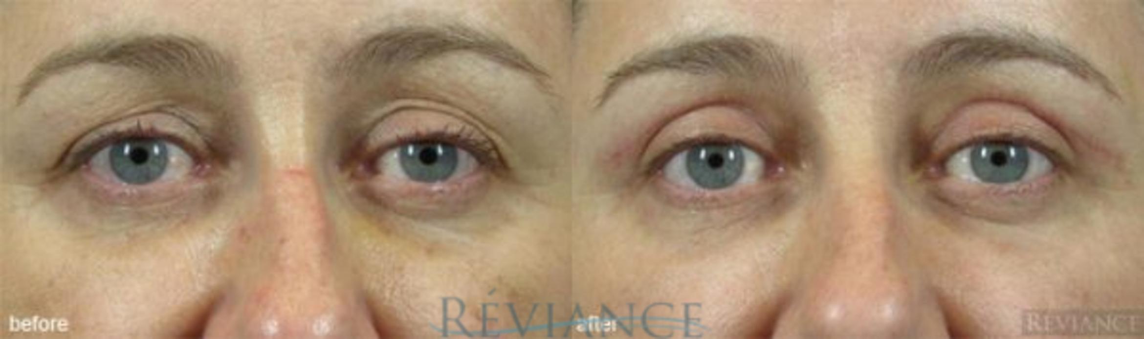 Before & After Eyelid Surgery Case 145 View #1 View in Portland, OR