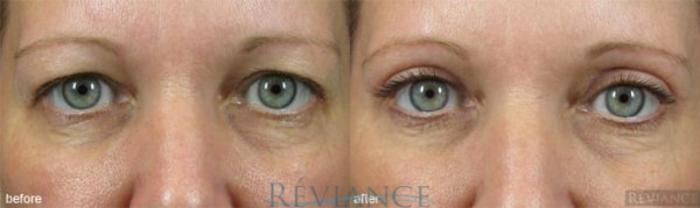 Before & After Eyelid Surgery Case 149 View #1 View in Portland, OR