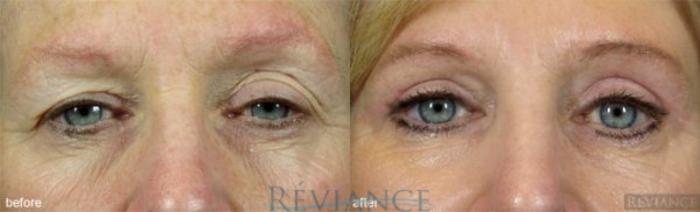 Before & After Eyelid Surgery Case 153 View #1 View in Portland, OR