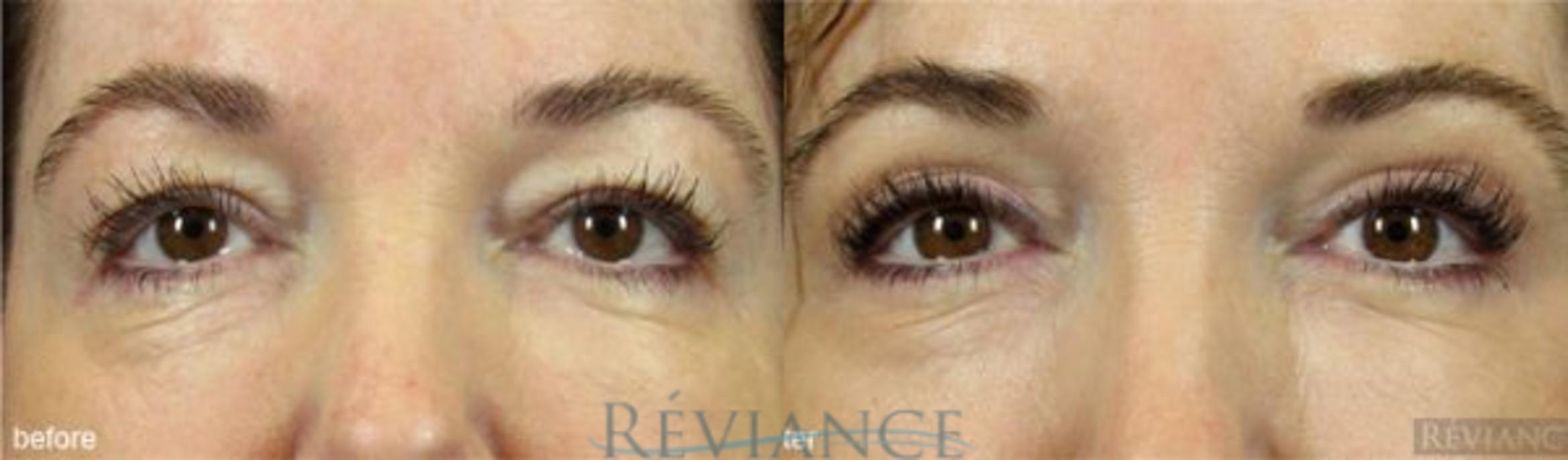 Before & After Eyelid Surgery Case 157 View #1 View in Portland, OR