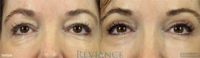Before & After Eyelid Surgery Case 157 View #1 View in Portland, OR