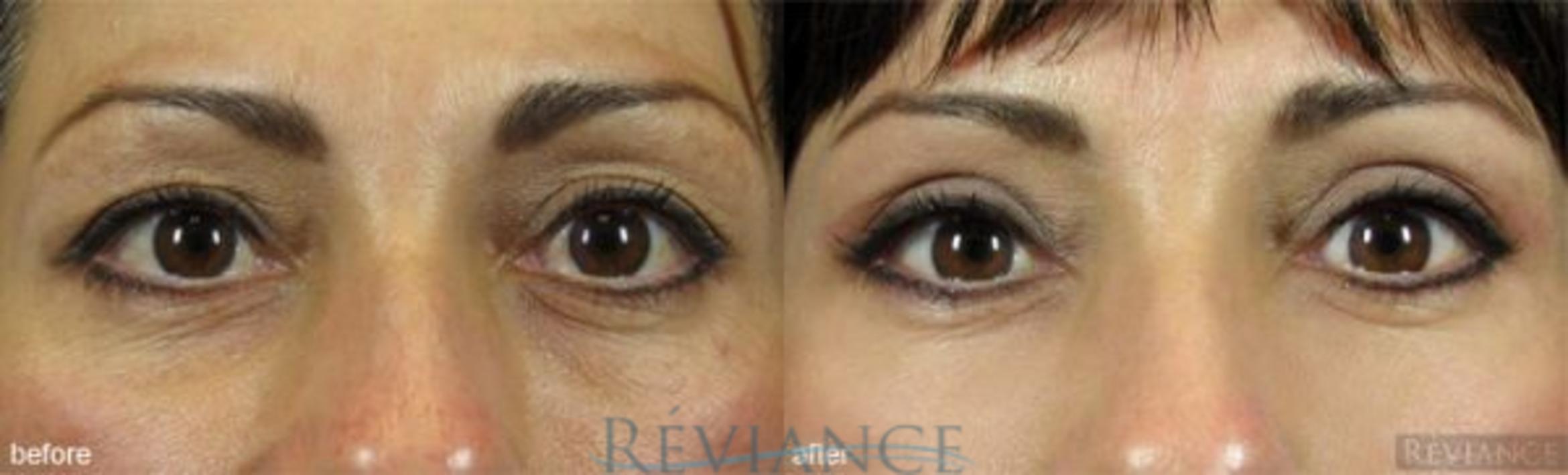 Before & After Eyelid Surgery Case 161 View #1 View in Portland, OR