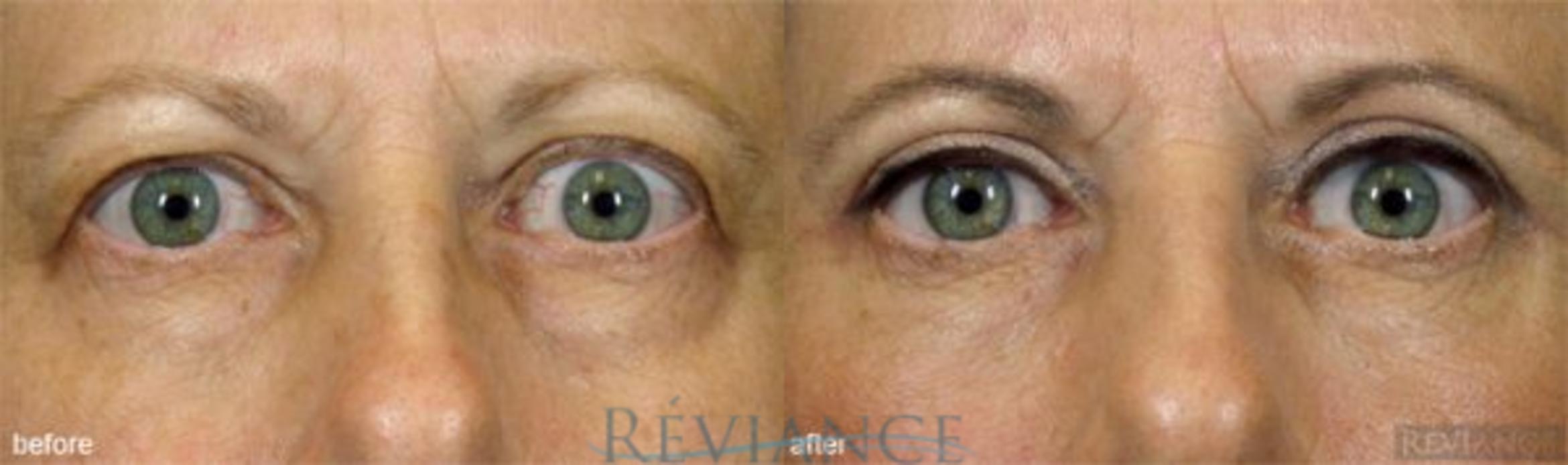 Before & After Eyelid Surgery Case 165 View #1 View in Portland, OR