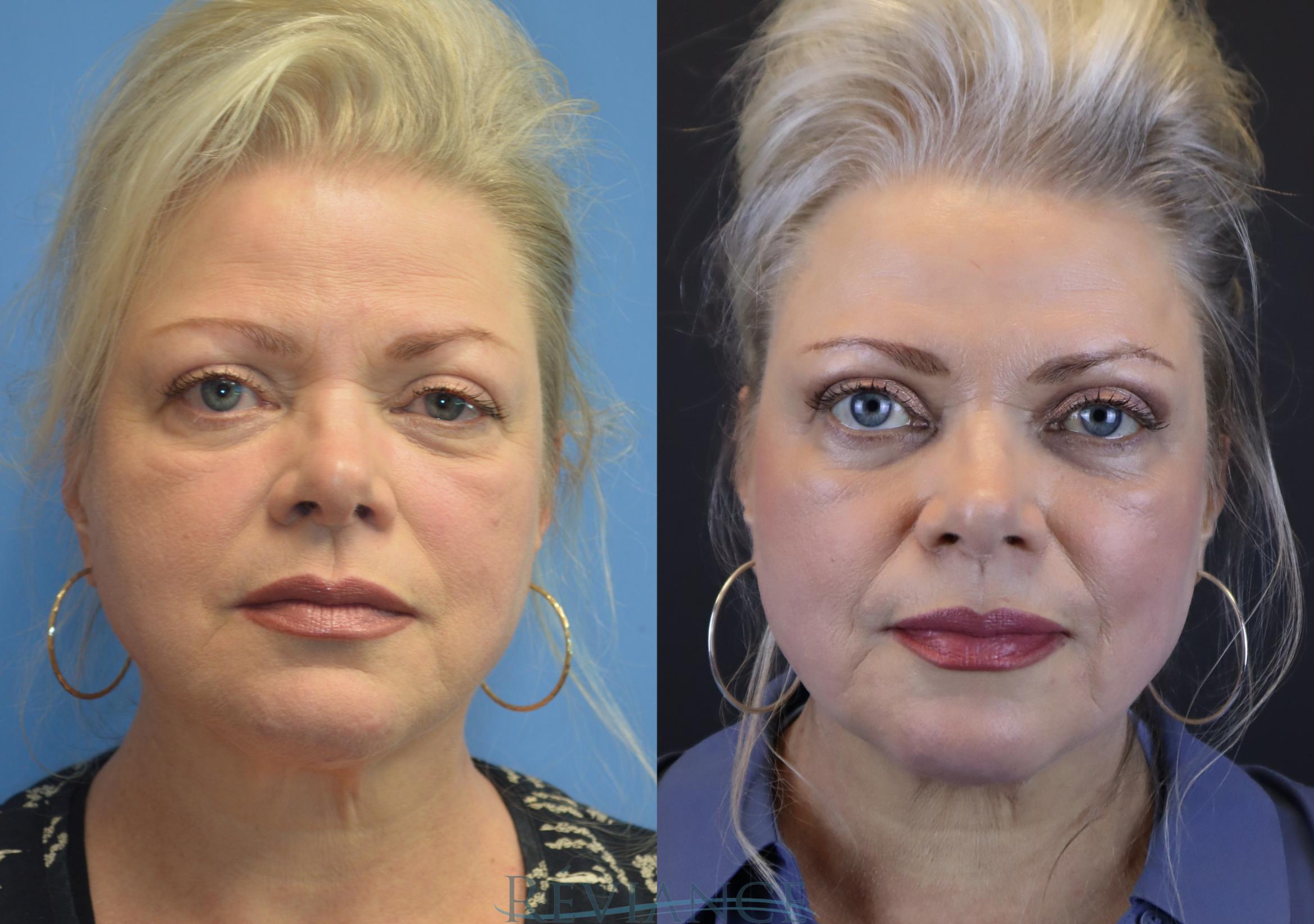 63 yo female bothered by heaviness of her upper eyelids and brows