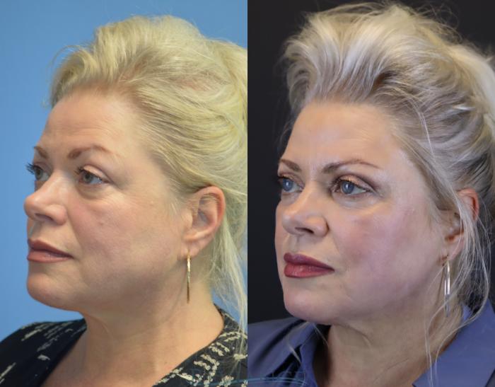 63 yo female bothered by heaviness of her upper eyelids and brows