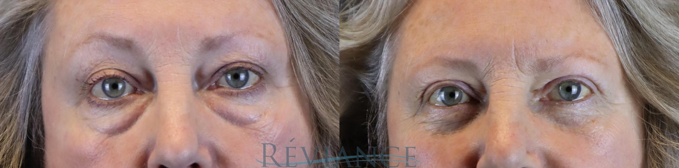 69 yo female bothered by lower eyelid fat pockets and upper eyelid heaviness